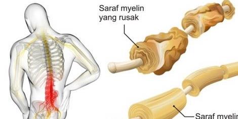 کاردرمانی برای گیلن باره