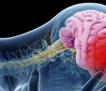 علائم سکته مغزی خاموش چیست؟