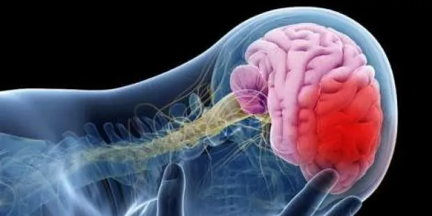 علائم سکته مغزی خاموش چیست؟