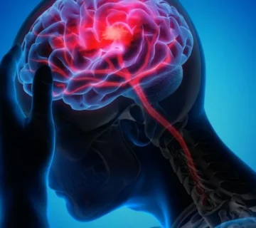 طول عمر پس از سکته مغزی