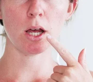 درمان خانگی لکنت زبان