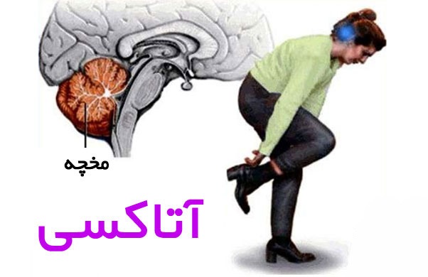 علائم و نشانه های فلج مغزی آتاکسی
