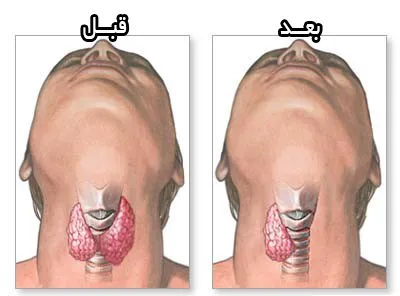 بررسی مشکلات گفتاری پس از عمل جراحی